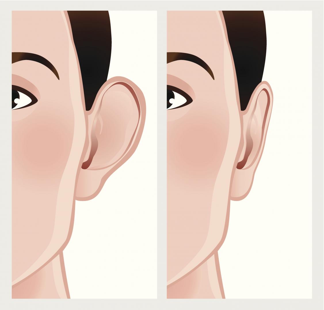 Otoplasty (Ear Surgery)
