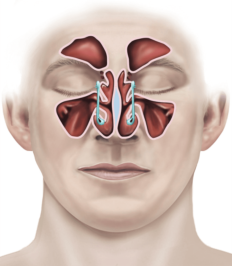 Functional Endoscopic Sinus Surgery