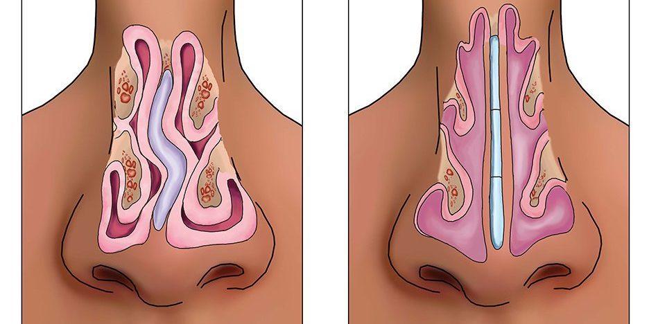 Septoplasty