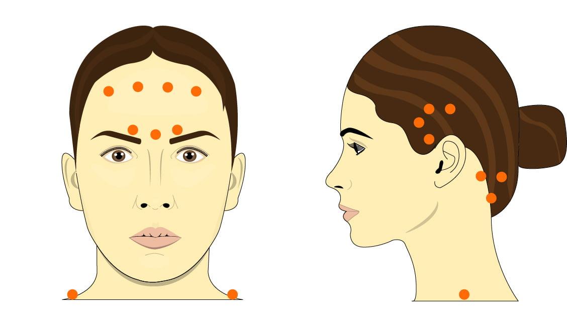 Botox para migraña